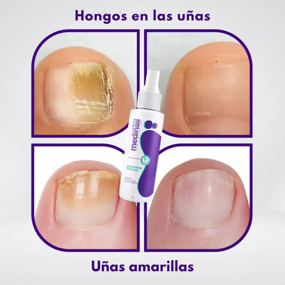 MEDINAIL™ – Dile adiós al mal aspecto de tus uñas en una semana